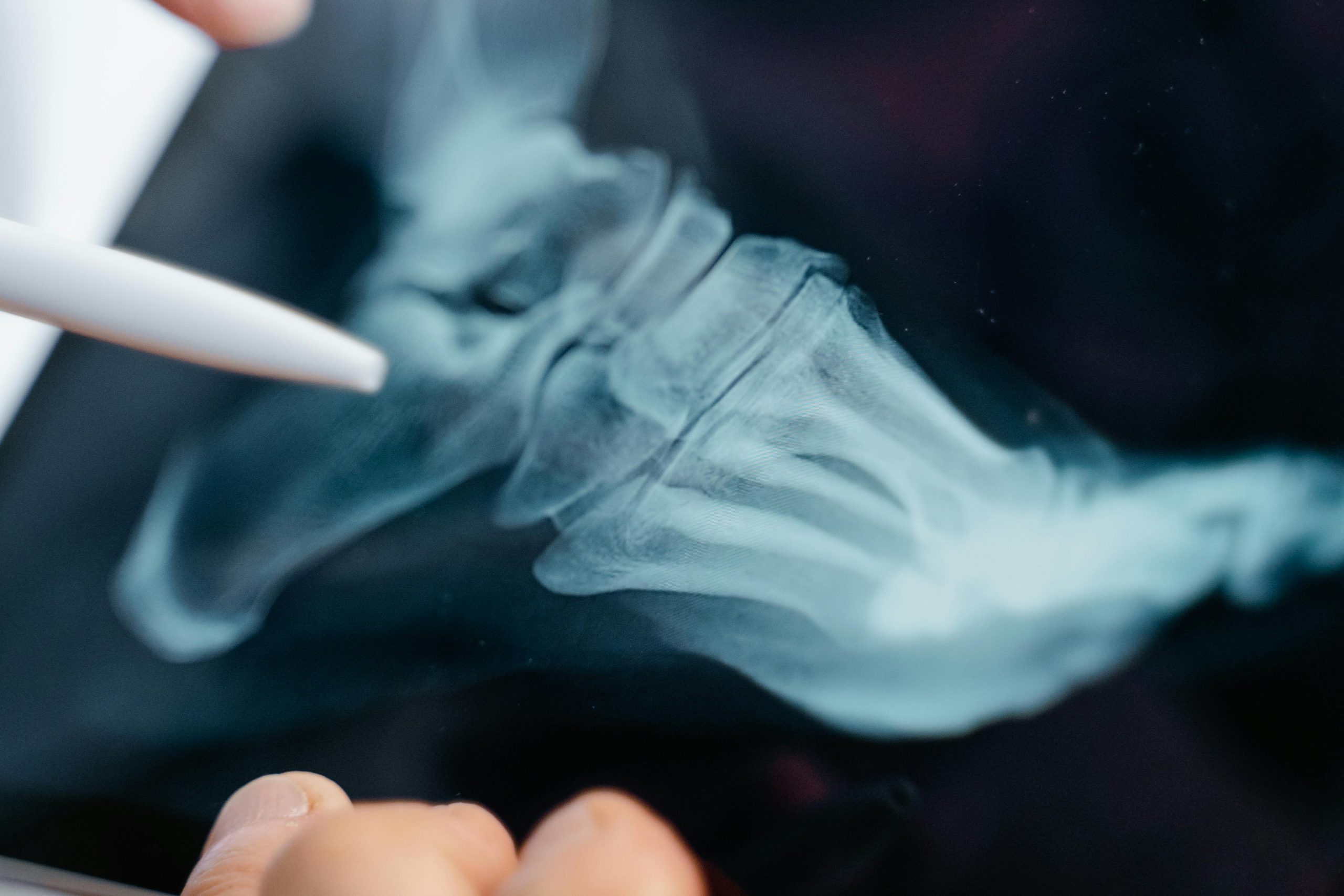 X-ray of foot